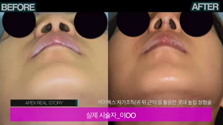 안전한 자가조직 코 성형은 에이펙스 성형외과와!