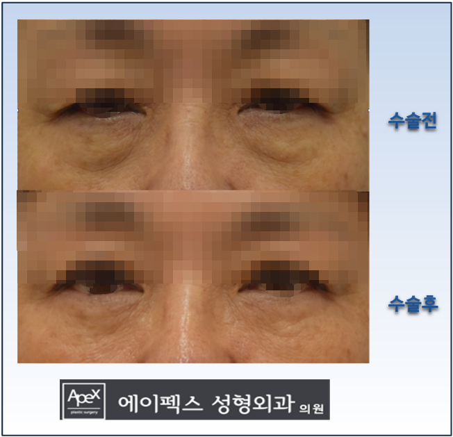 효도성형,하안검 수술 잘하는 병원 /에이펙스성형외과~