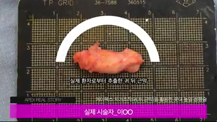 코성형은 에이펙스!!