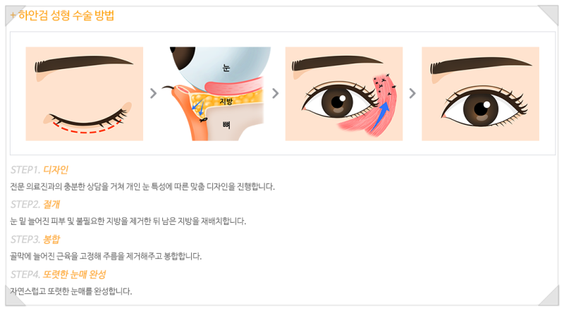 ☆눈꺼풀,눈밑처짐☆보험적용으로 상안검, 하안검, 안검하수를 이 가격에?!? 에이펙스성형외과에서 부담없는 금액으로 만나보세요!