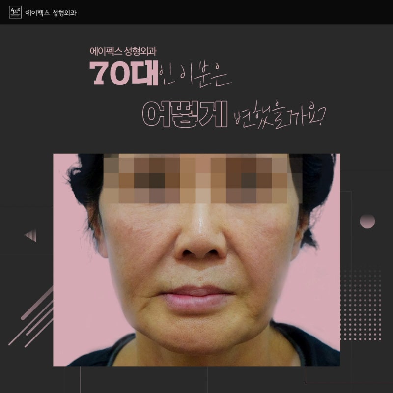 ☆주름성형,동안성형☆ 에이펙스성형외과! 확실하게 젊어지세요~!