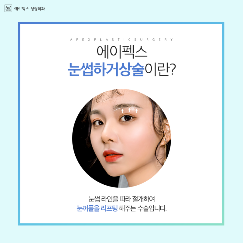 ☆눈썹하거상술☆ 두툼한 눈, 에이펙스성형외과 눈꺼풀 리프팅으로!