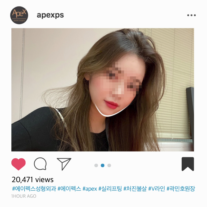 ♡리프팅성형♡ 페이스리프팅, 리프팅 성형 추천 "에이펙스성형외과"