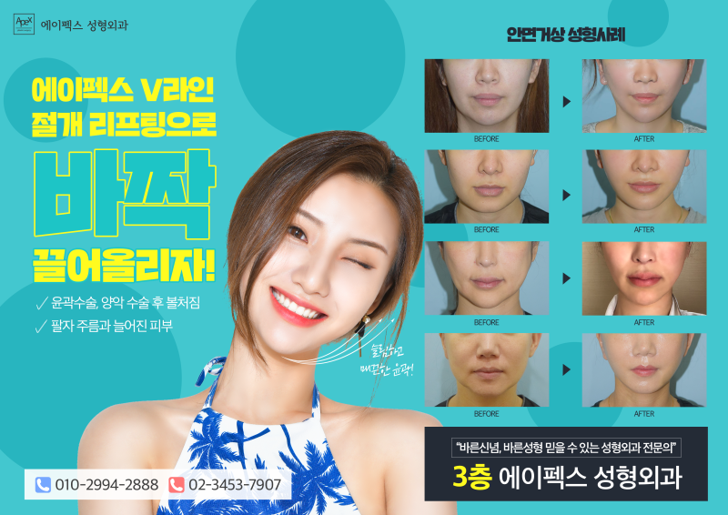 ☆안면거상☆ 페이스리프팅, 절개리프팅 추천 "에이펙스성형외과"