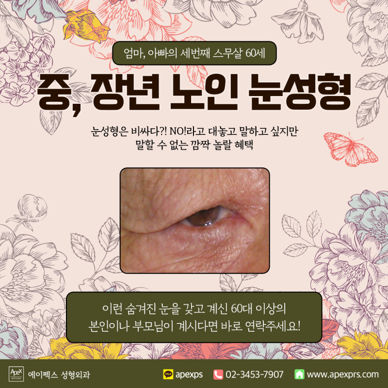 ☆부모님 효도 눈성형☆ 상안검 수술은, 에이펙스성형외과