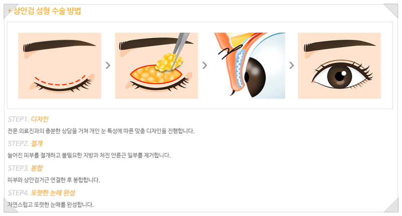 상안검도 성형외과에서, 부모님 청춘 리턴 프로젝트 "에이펙스성형외과"