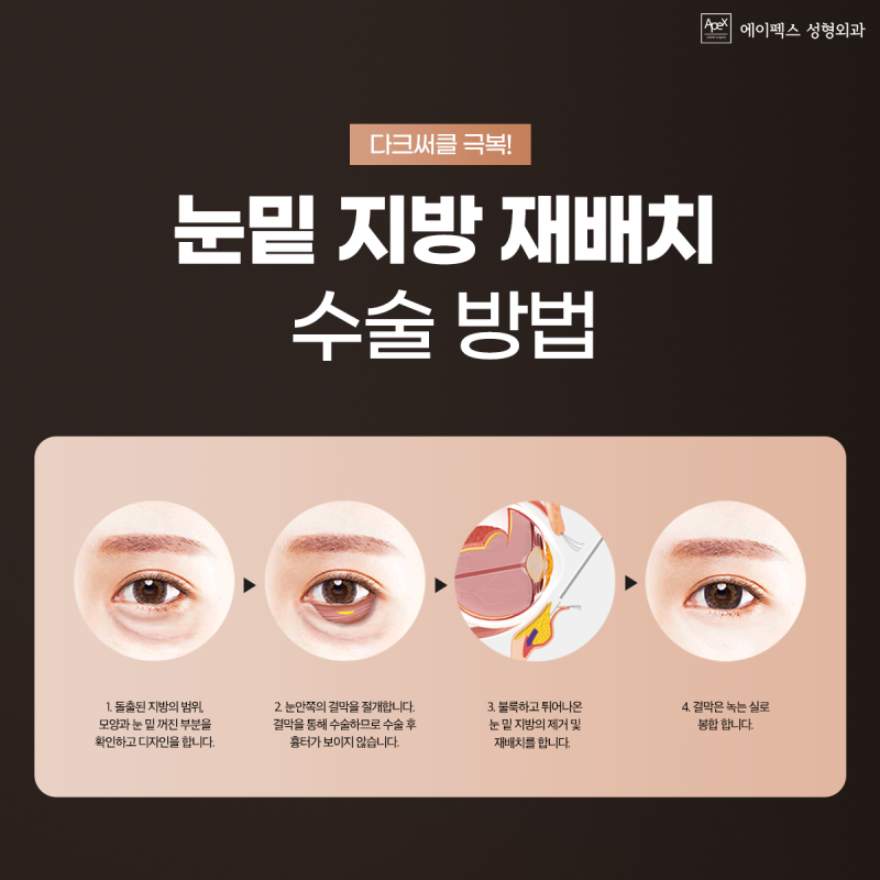 칙칙한 얼굴 다크서클, 눈밑지방재배치로 환하게 밝게! "에이펙스성형외과"