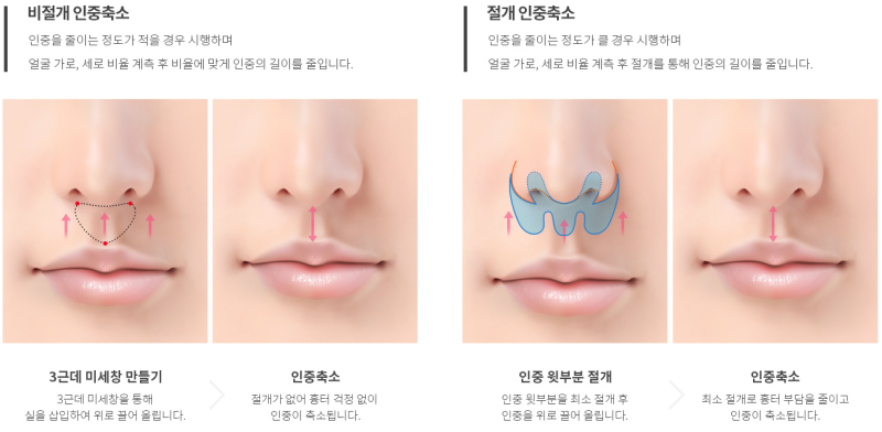 인중축소&입술성형 "긴 인중은 줄이고 적절한 입술 볼륨으로 균형있게, 에이펙스성형외과"
