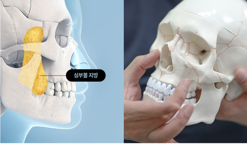 심술보, 불독살 "심부볼 지방제거" 에이펙스성형외과