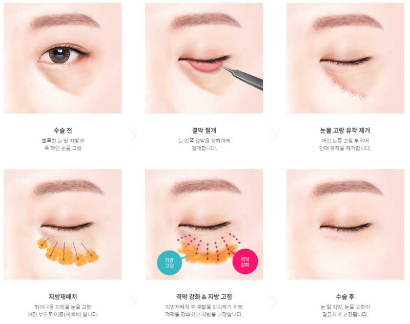 눈 밑 고랑, 눈 밑 지방 해결 "에이펙스 결막 눈밑지방재배치"