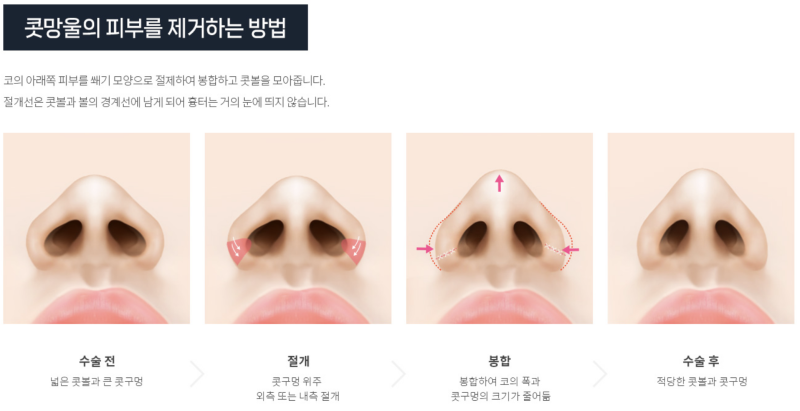 넓게 퍼진 콧볼을 얼굴 균형에 맞게 줄이는 콧볼축소 성형 "에이펙스성형외과"