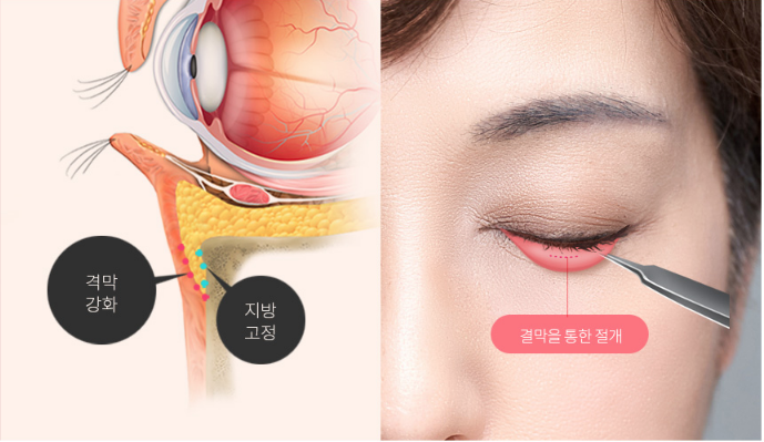 눈 밑 조명, 다크서클 없이 맑고 환한 인상 "에이펙스성형외과 결막 눈밑지방재배치"