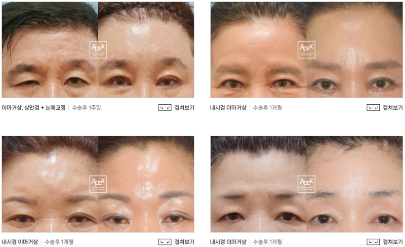 이마 주름, 처진 눈썹&눈꺼풀, "이마거상, 에이펙스성형외과"