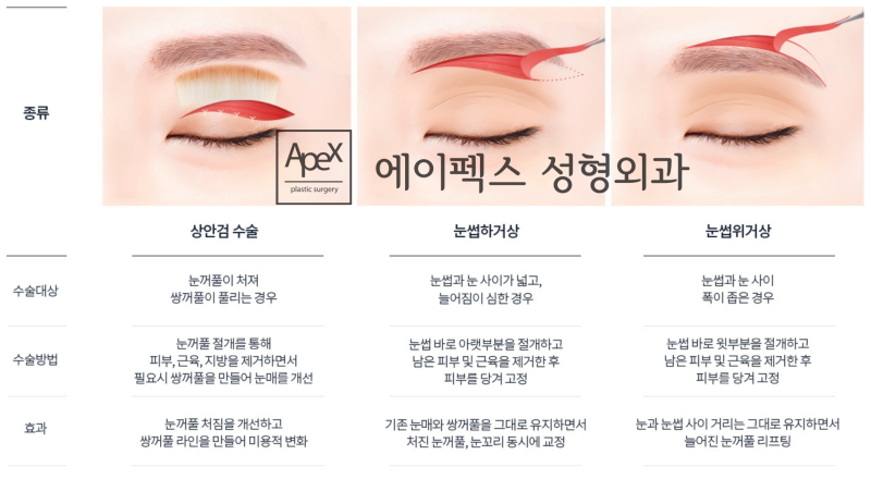 중년 눈성형은 따로 있다! 처진 눈꺼풀 <상안검 눈성형>, 에이펙스성형외과