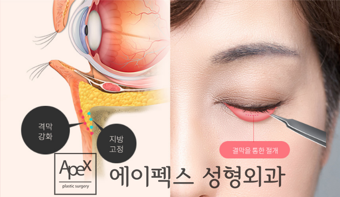 <에이펙스성형외과> 볼록한 눈 밑 지방, 눈밑지방재배치로 다크서클 없이 환하게!