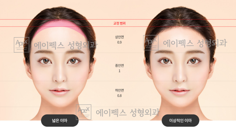 "이마축소&이마거상" 예쁜 이마성형은, 에이펙스성형외과
