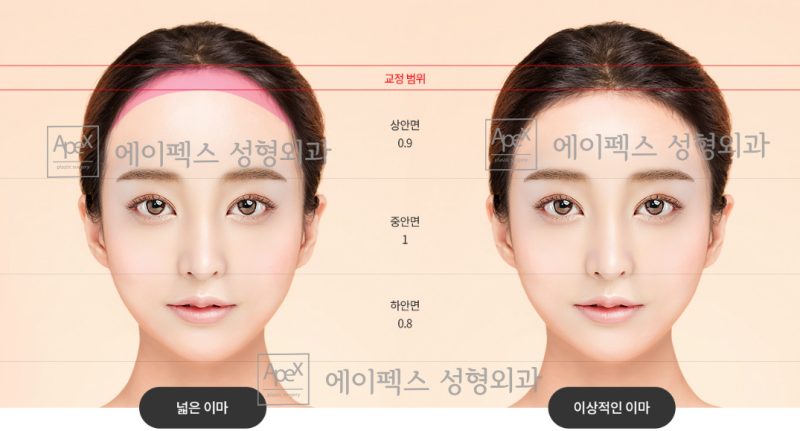 예쁜 이마를 위한 이마성형, "이마축소,이마거상" 에이펙스성형외과