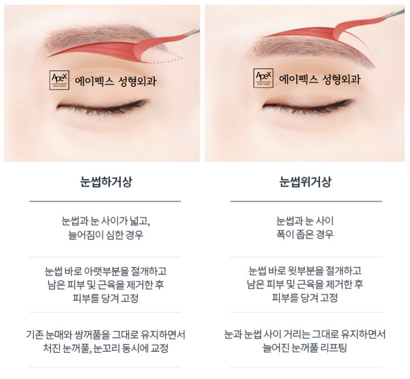 에이펙스성형외과 "눈썹과 눈사이, 눈썹거상술로 조화롭게"