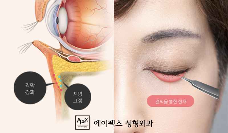 피곤해 보이는 다크서클, 환하게 밝히자! "에이펙스 결막 눈밑지방재배치"