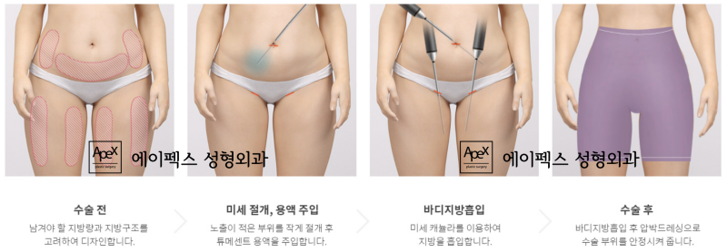 배꼽티 입을 준비 됐어~? 뱃살을 줄이는 복부 지방흡입, 에이펙스성형외과