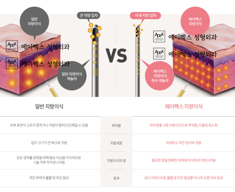 에이펙스성형외과, 빵빵한 얼굴볼륨을 위한 ♥자가 지방이식♥