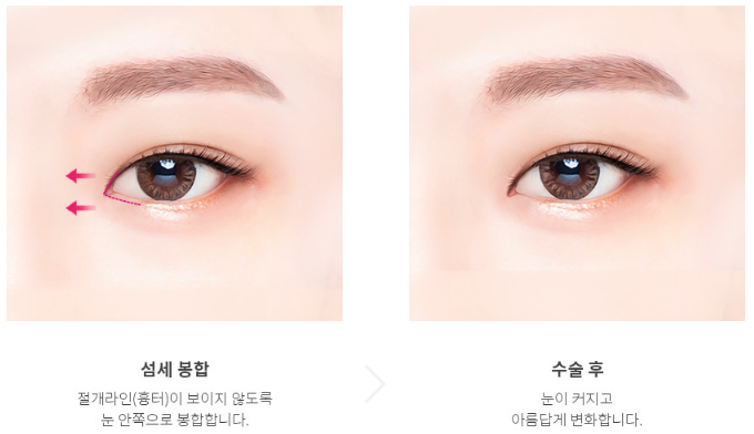 에이펙스성형외과 트임성형, 가로 세로 길이 확장으로 시원한 눈매