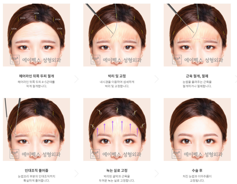 강력한 안면거상, 에이펙스성형외과 "스마스 안면거상"