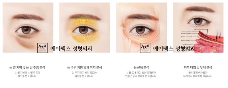 에이펙스성형외과, 중년 눈꺼풀처짐, 아이백 성형 "상안검&하안검"