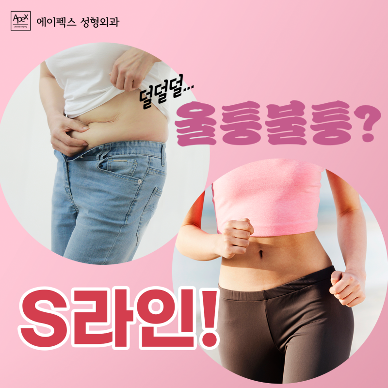 출렁 뱃살, 운동만으로 부족할때! 지방흡입으로 슬림하게 "에이펙스성형외과"