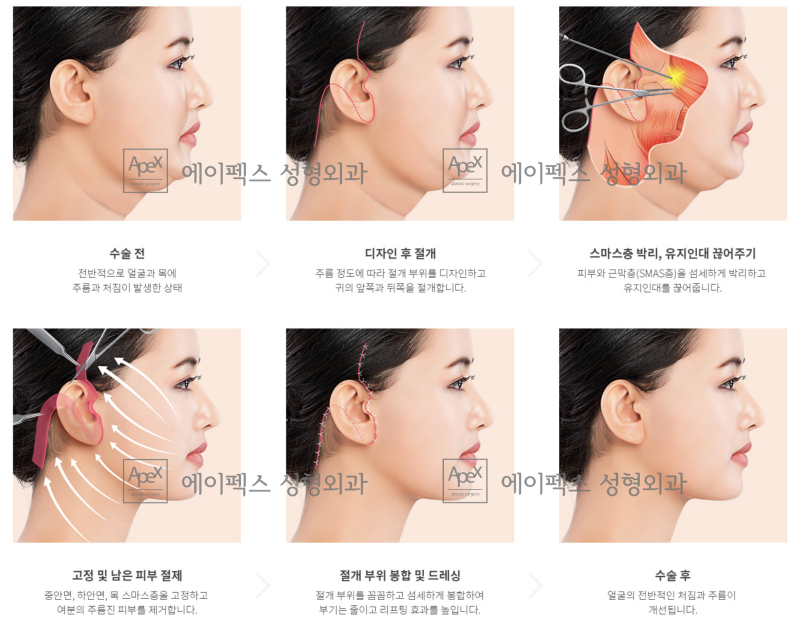 안면거상 전문 성형외과, 갸름한 얼굴라인을 원한다면 에이펙스성형외과