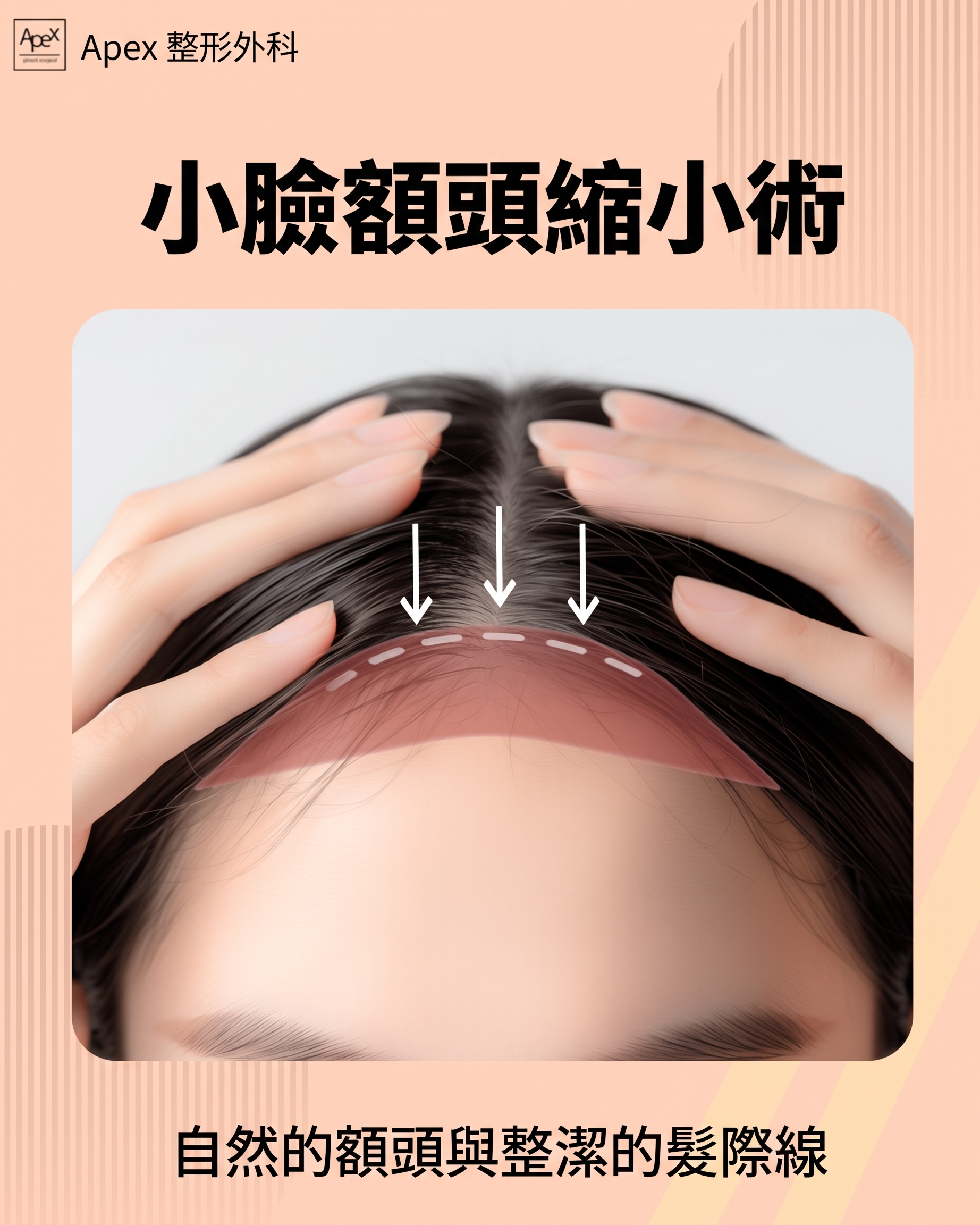 獲取正確的整容資訊，不再迷茫，直奔「APEX整形外科」 사진 8