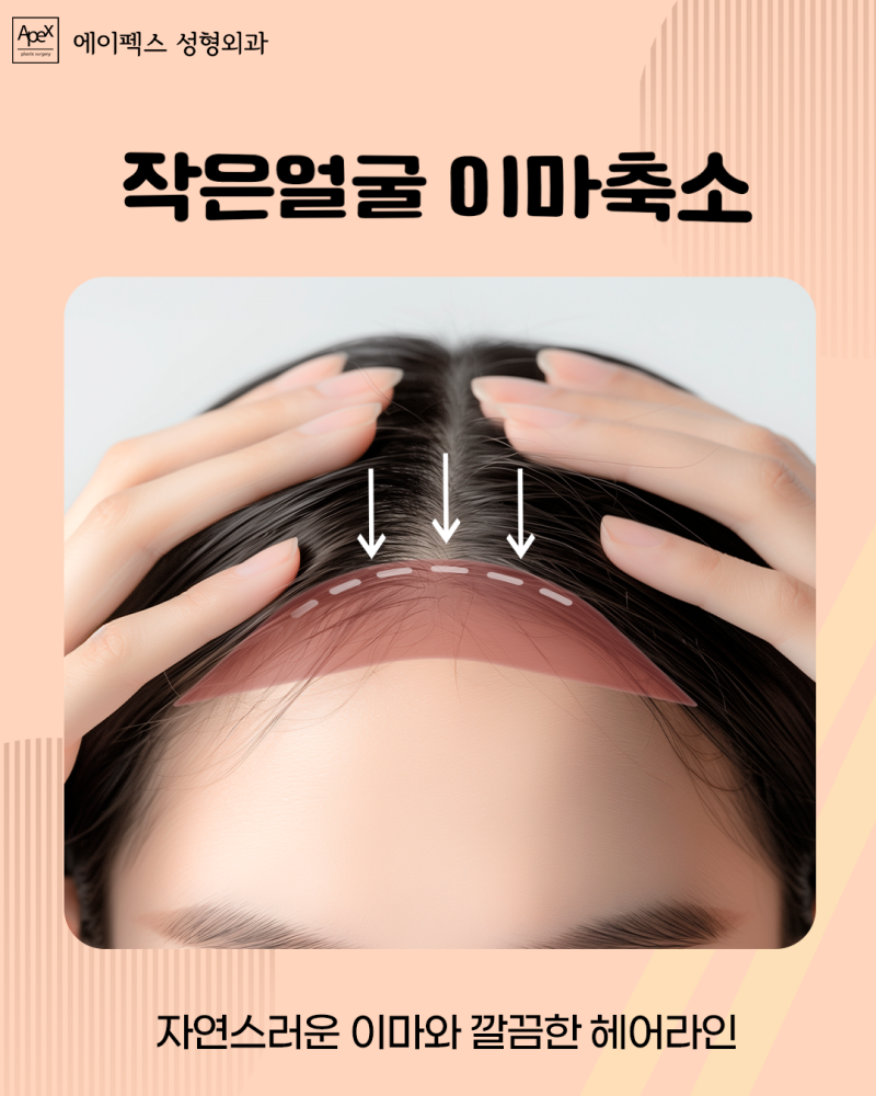 성형에 대한 바른 정보, 헤매지 말고 "에이펙스성형외과" 사진 8
